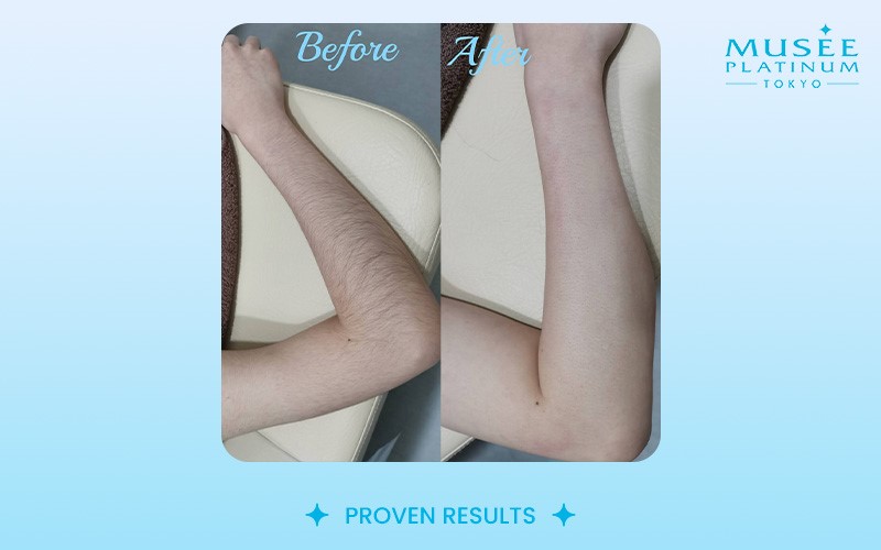 before after hair removal comparison