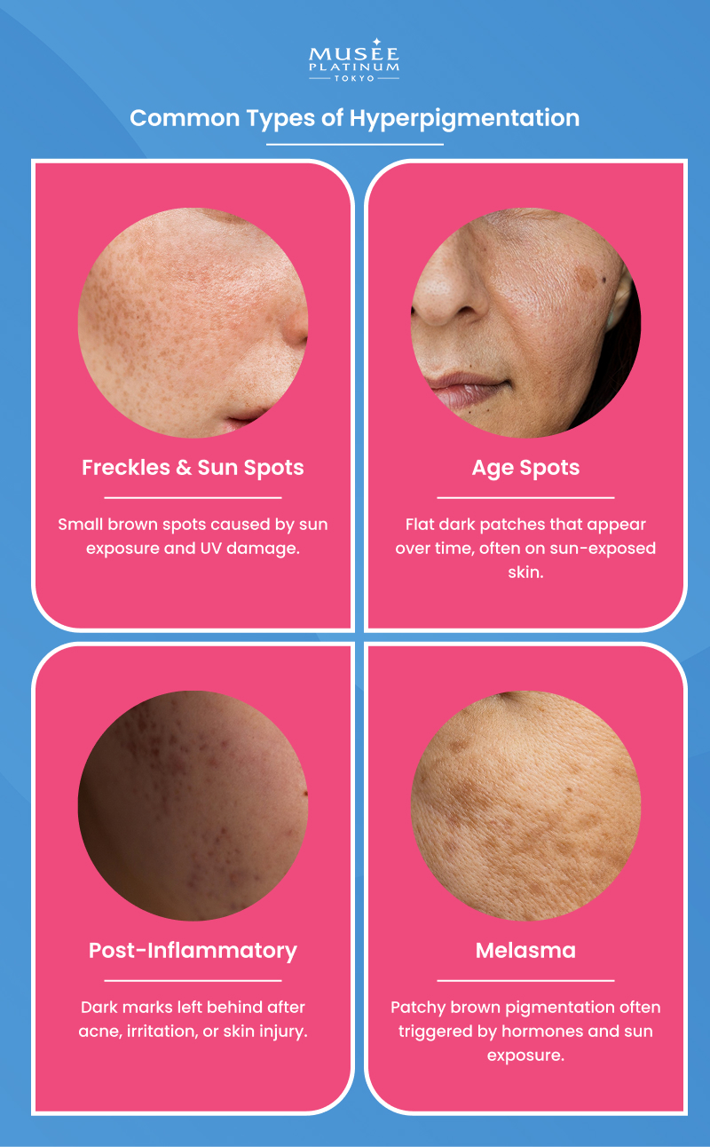 common types of hyperpigmentation