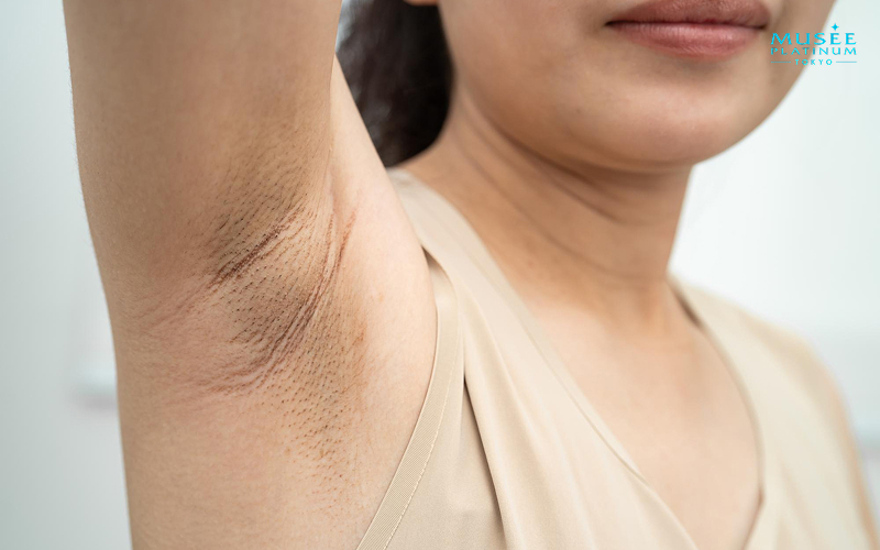 dark underarm skin before a whitening treatment