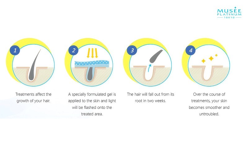 musee ssc hair removal treatment process