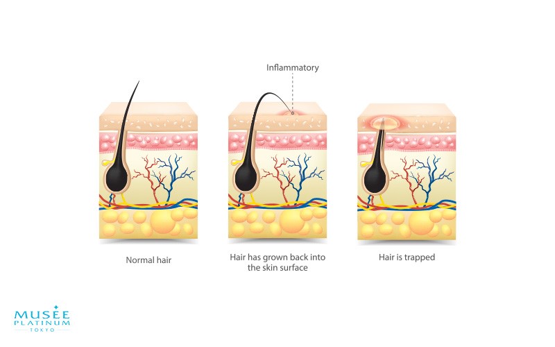 Ingrown Hair On Face