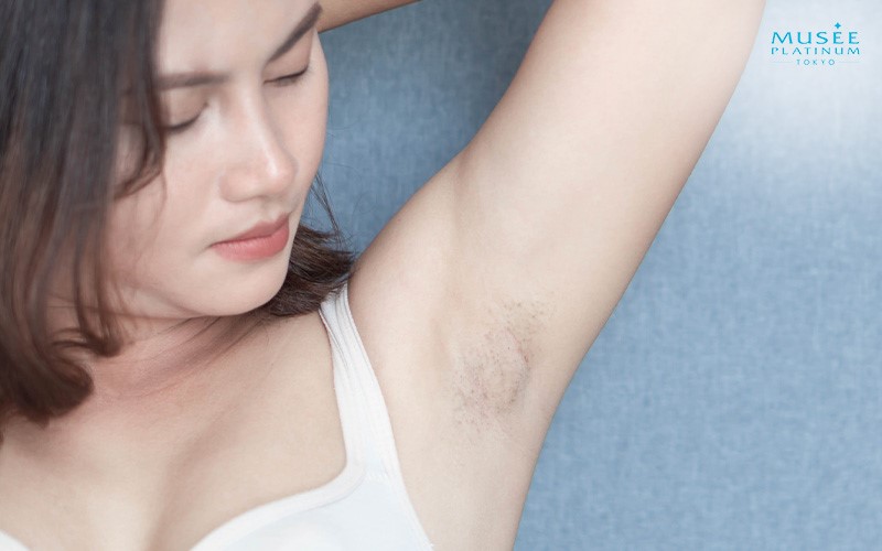 A women with dark armpit