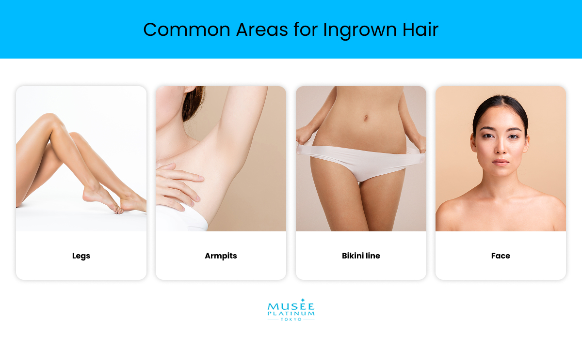 infographics-common-areas-for-ingrown-hair