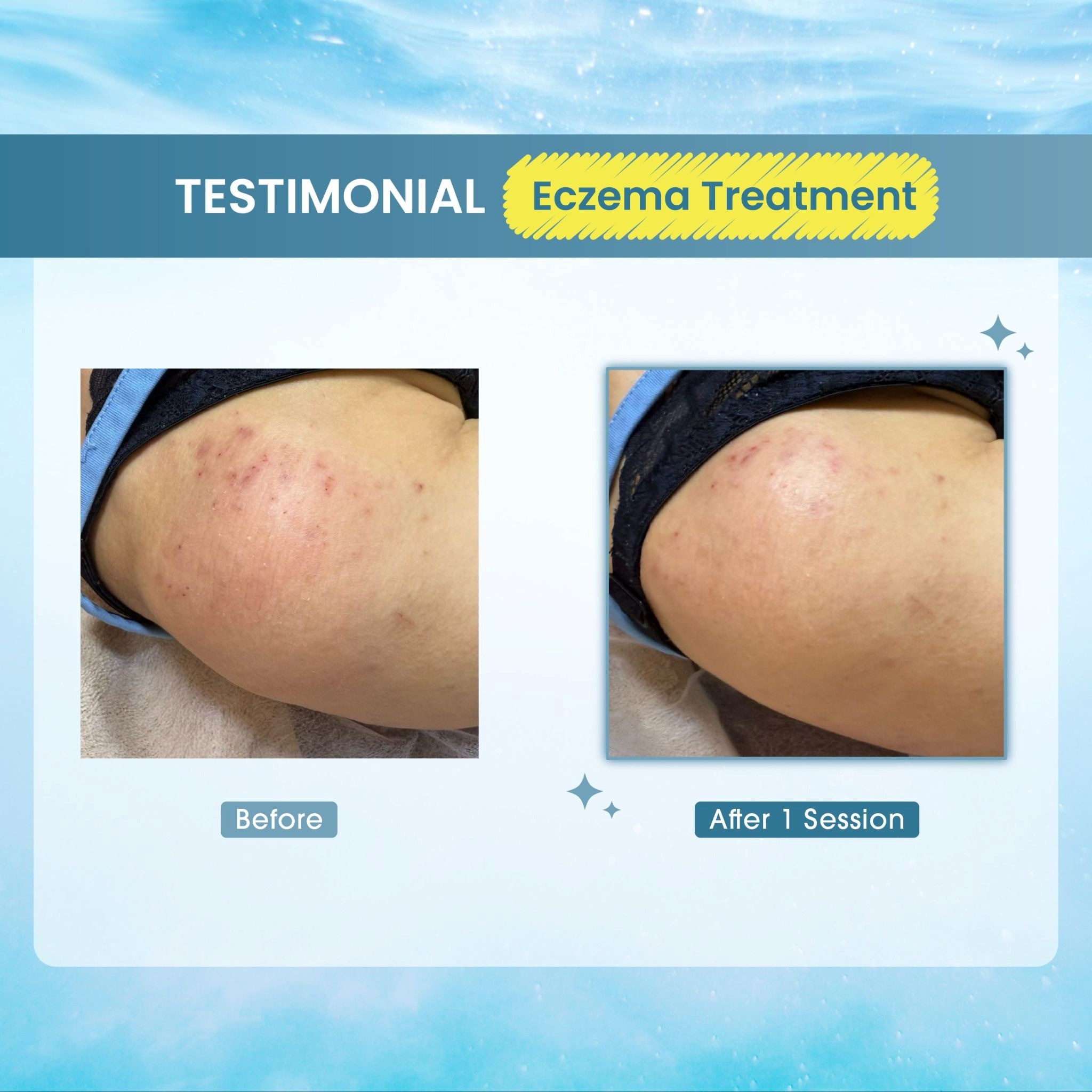 Eczema Treatment 1 Session