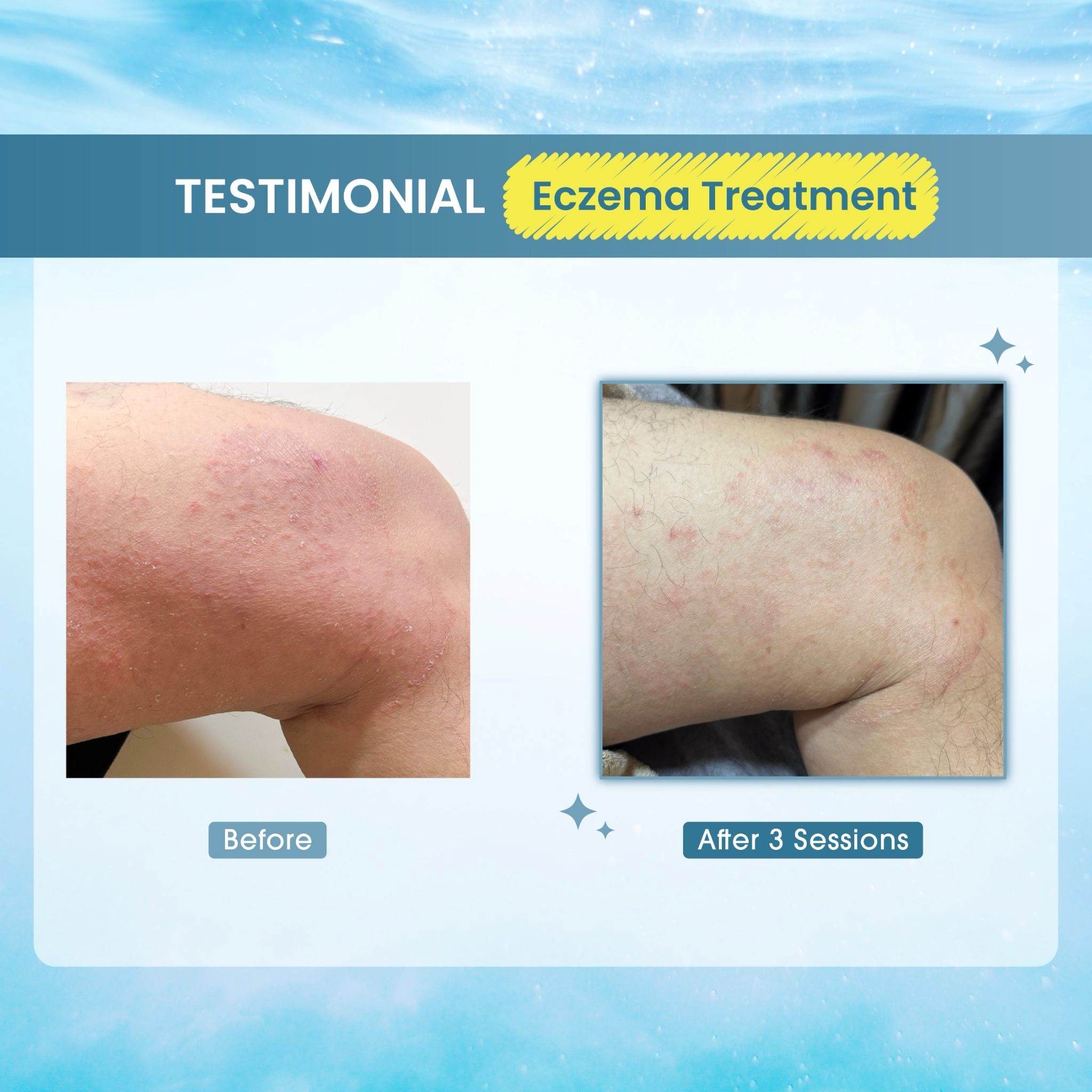 Eczema Treatment 3 Sessions