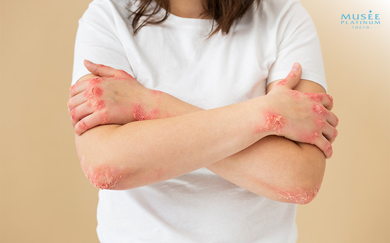 Women with Red Scaly Patches Forearms