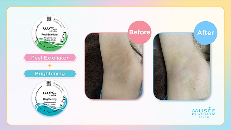 Before and After Image of M.I.T Treatment - Wishpro Peel Exfoliator and Brightening Treatment