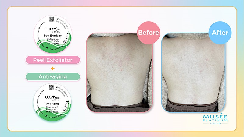 Before and After Image of M.I.T Treatment - WishproPeel Exfoliator and Anti-Aging Treatment